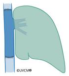 Vue détaillée: remplacement du cava (remplacement de la veine cave)